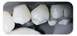 Hawe™ Diamond Strips