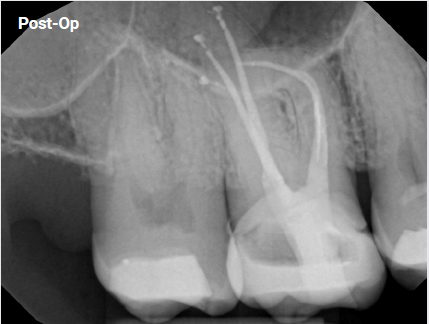 Symptomatic irreversible pulpitis