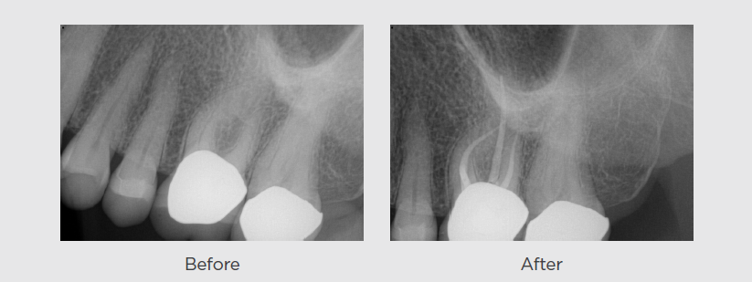 The patient presented with temperature sensitivity in the upper left quadrant