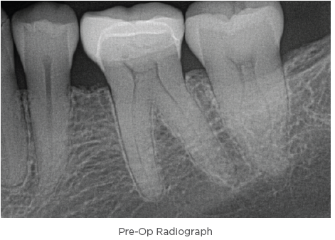 Traverse™ & elements™ IC Endodontic Treatment - Case Study