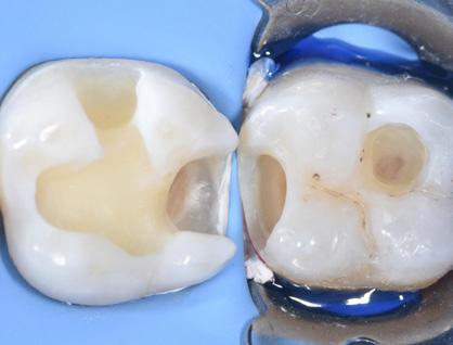 Bulk Fill composites to solve everyday direct posterior restorations