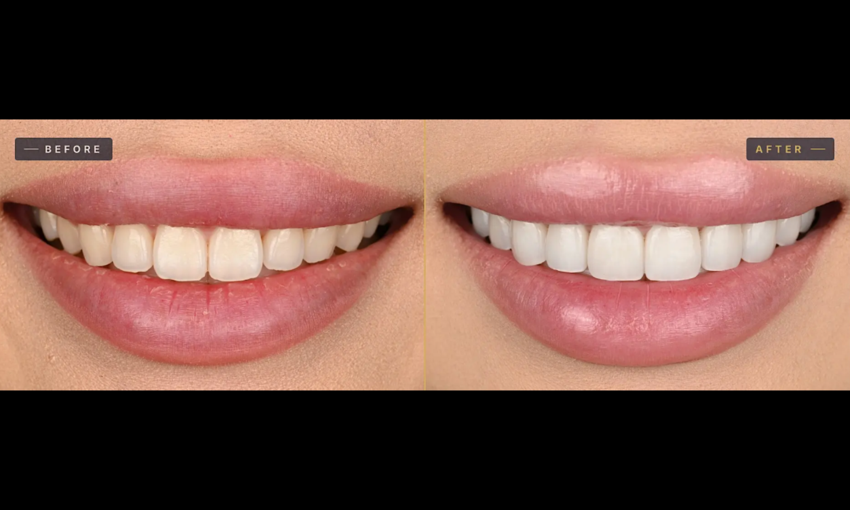 Exceptional Porcelain Veneers (EPV) - August 2026