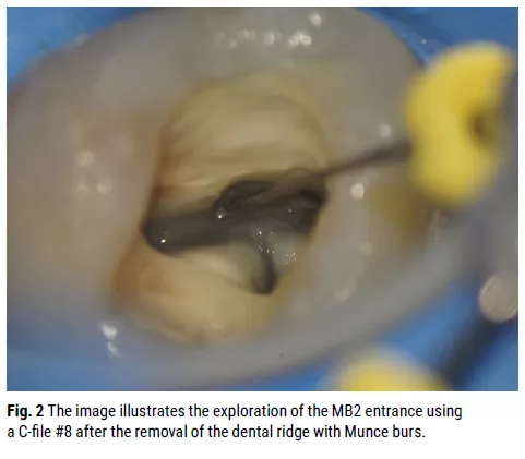 Fig. 2 The image illustrates the exploration of the MB2 entrance using a C-file #8 after the removal of the dental ridge with Munce burs. Fig. 2 The image illustrates the exploration of the MB2 entrance using a C-file #8 after the removal of the dental ridge with Munce burs.