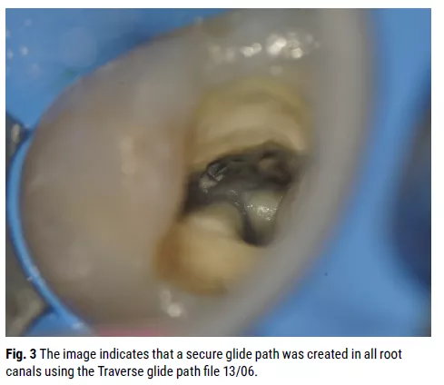 Fig. 3 The image indicates that a secure glide path was created in all root canals using the Traverse glide path file 13/06. Fig. 3 The image indicates that a secure glide path was created in all root canals using the Traverse glide path file 13/06.