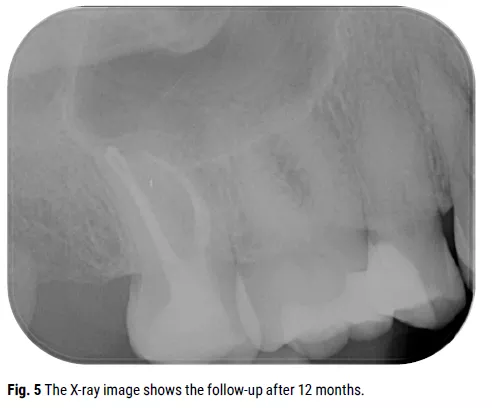 Fig. 5 The X-ray image shows the follow-up after 12 months Fig. 5 The X-ray image shows the follow-up after 12 months