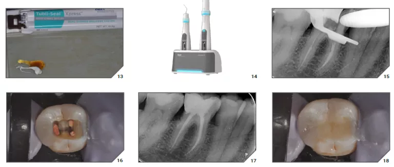 Kerr Endodontics offers a complete range of instruments that enable efficient and reproducible results with chairside time savings. Zenflex files provide controlled tapering to minimize instrument binding during canal preparation. “A controlled shape memory (with a different alloy for each diameter) for perfect respect of canal trajectories.” Kerr Endodontics offers a complete range of instruments that enable efficient and reproducible results with chairside time savings. Zenflex files provide controlled tapering to minimize instrument binding during canal preparation. “A controlled shape memory (with a different alloy for each diameter) for perfect respect of canal trajectories.”