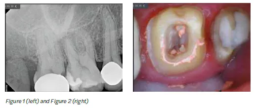 The canals were obturated using SimpliCore™ for Zen- Flex™ ONE Primary (Figures 2 and 3).