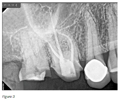 The canals were dried before placing ZenSeal™ Bioceramic Sealer (Figure 3). 5. The canals were obturated