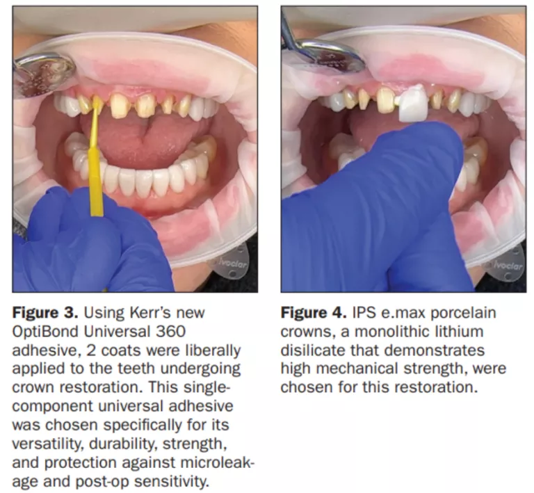dr savage obu 360 case #2