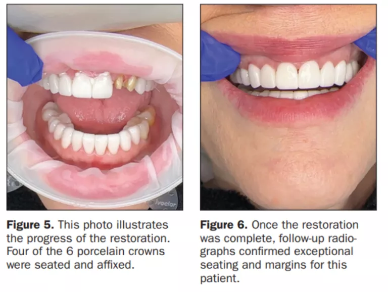 dr savage obu 360 case #3