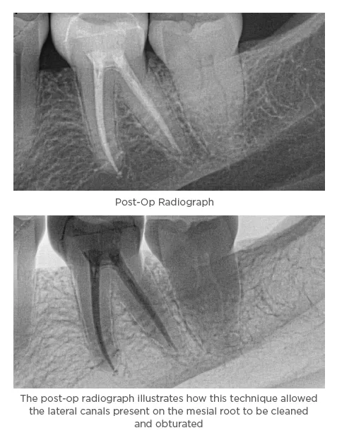 The post-op radiograph illustrates how this technique allowed the lateral canals present on the mesial root to be cleaned and obturated Traverse and elements IC are trademarks of Kerr