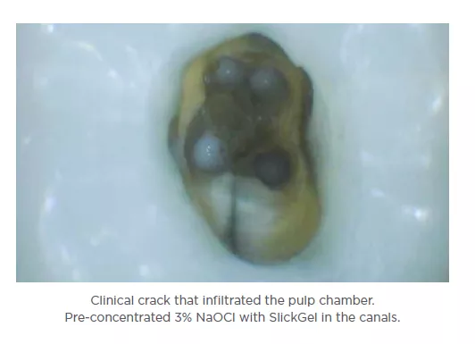 Final obturation with gutta percha using elements™ IC