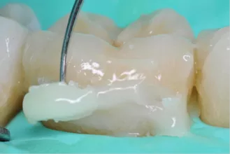 Cementation
