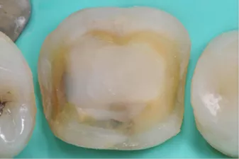 Fabrication of the indirect restoration