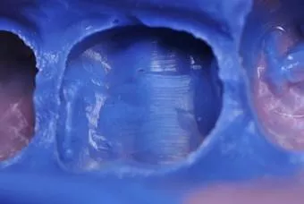 Finalized tooth preparation