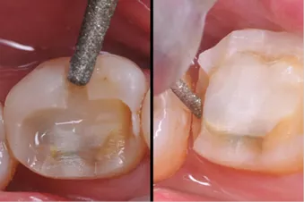 Guide for occlusal reduction