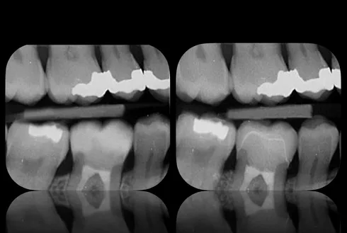 Occlusal adjustment