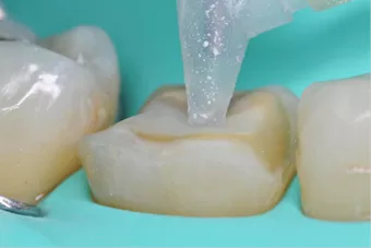 Rubber dam placement