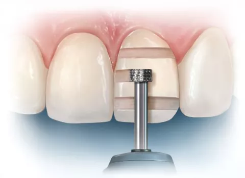 NTI® Depth Markers and Axial Reduction Diamonds