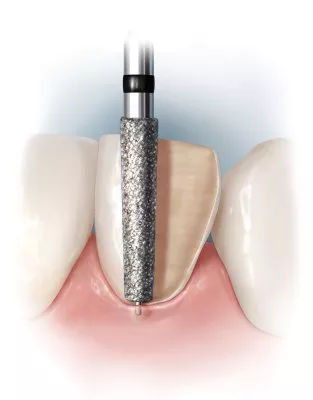 NTI® Guide Pin Diamonds 